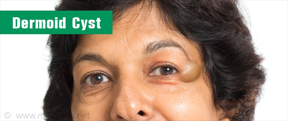 dermoid cyst ovary eye