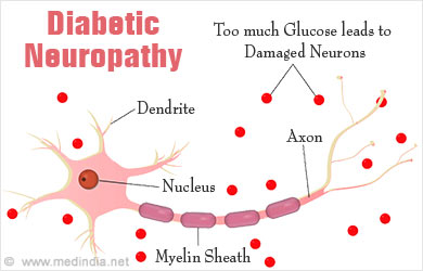 Diabetic Neuropathy - Types, Causes, Symptoms, Diagnosis, Complication ...