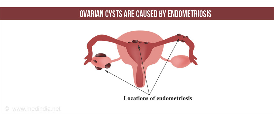 Ovarian Cysts Types Causes Symptoms Diagnosis Treatment 4533