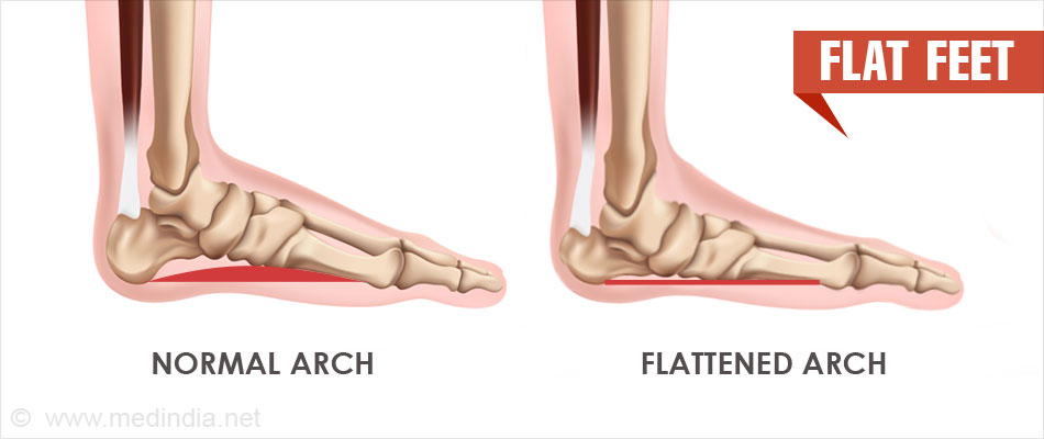 Flat Feet | Pes Planus - Causes, Symptoms, Diagnosis, Treatment