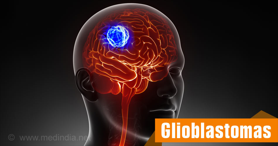 Glioblastoma Multiforme Astrocytoma Grade 4 Types Causes Symptoms 