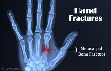 Hand Fractures – Causes, Symptoms, Diagnosis, Treatment