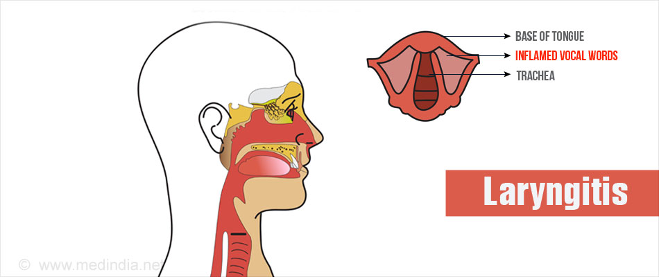 Laryngitis Causes Symptoms Diagnosis Treatment