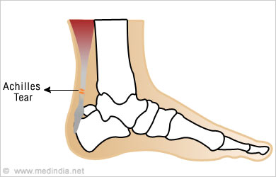 Leg Injuries and Disorders - Common Problems - Conditions