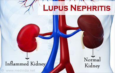 Lupus Nephritis Types