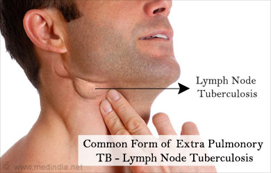 Extra Pulmonary Tuberculosis - Symptoms, Signs, Causes, Risk factors