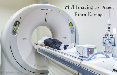 Dementia MRI Scan