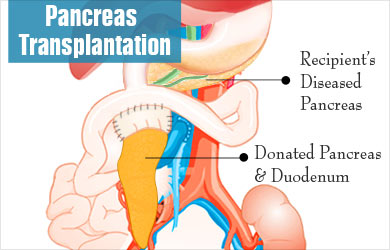 Pancreas Transplantation - Procedure, Evaluation, Preparation, Surgery, After care