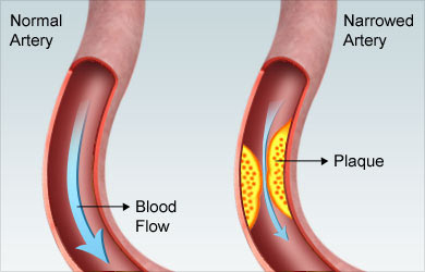 PLAC Test for Cardiovascular Disease