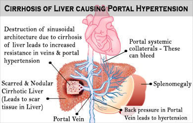 portal hypertension collaterals