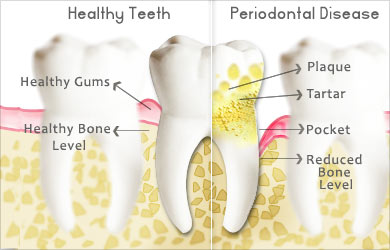 Dental Care during Pregnancy