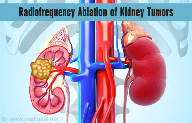 Radiofrequency Ablation (RFA) of Kidney Tumors