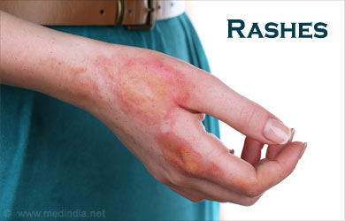 stache rash treatment