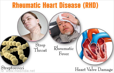 Rheumatic Heart Disease (RHD) - Causes, Risk factors, Symptoms ...