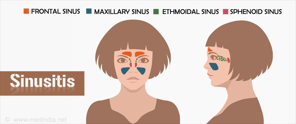 Sinusitis - Types, Causes, Symptoms, Diagnosis, Complications And Treatment