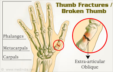 Thumb Fractures / Broken Thumb - Causes, Symptoms, Diagnosis, Treatment