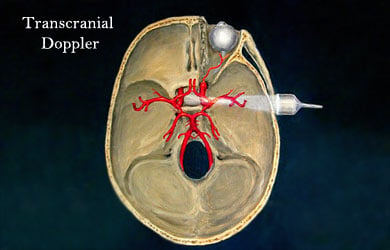 transcranial doppler technique