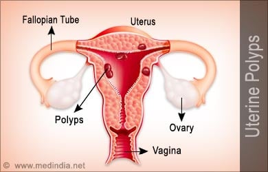 Uterine Polyps | Endometrial Polyps - Causes Symptoms ...