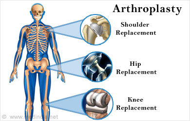 Arthroplasty - Surgical Procedure, Risks, Complications, Recovery ...