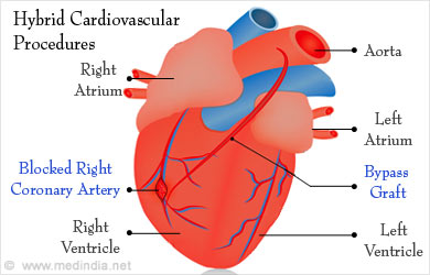 Hybrid Heart Surgery - Requirements, Advantages, Disadvantages