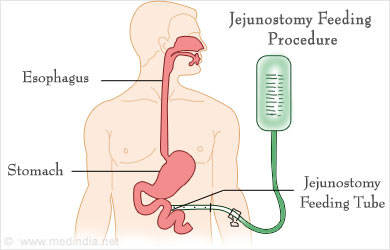 Whipple S Surgical Procedure Pancreaticoduodenectomy For Cancer