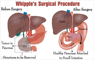 Whipple Surgery Helps Me Be Healthy - Let's Win Pancreatic Cancer